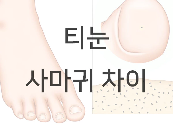 티눈 사마귀 차이